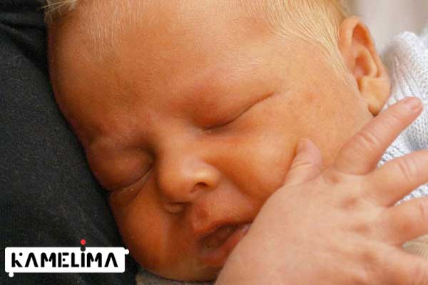 عوارض زردی نوزاد چیست؟