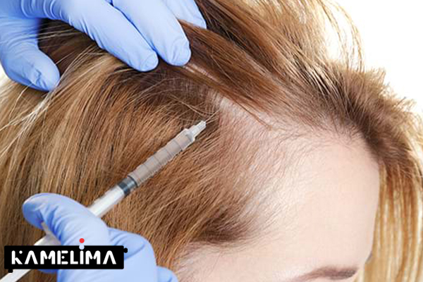 تزریق پلاسمای غنی از پلاکت برای ریزش مو