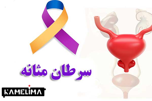 علل سرطان مثانه