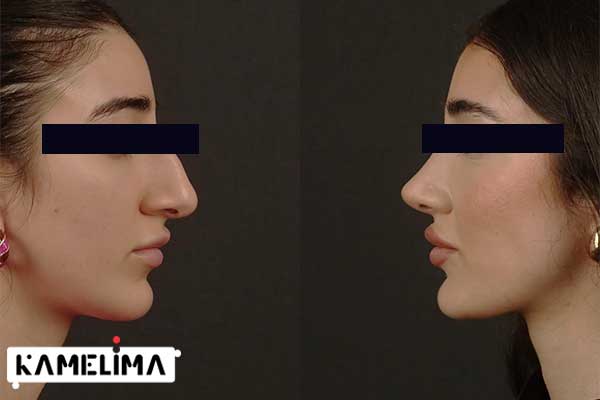 خطرات عمل رینوپلاستی rhinoplasty