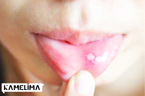 انواع زخم های دهان
