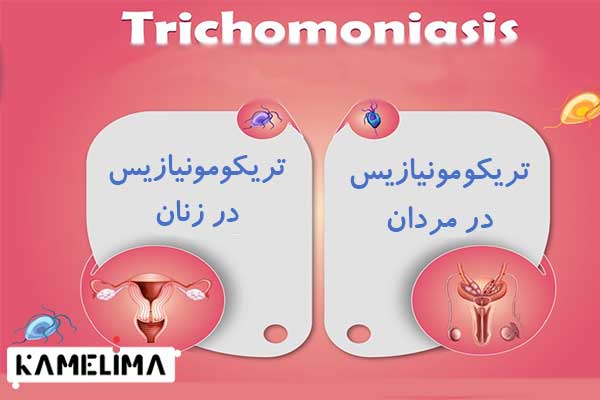 علائم بیماری تریکومونیازیس در زنان و مردان