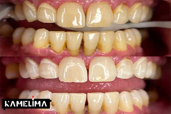 روش های خانگی طبیعی برای درمان زرد شدن دندان ها