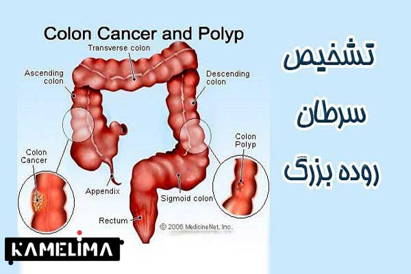 علائم سرطان روده بزرگ یا کولون 