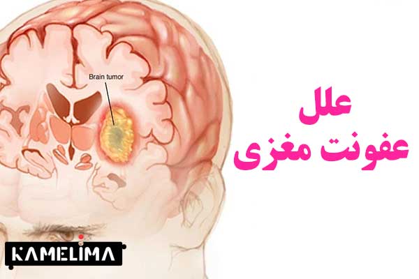 مهمترین علل عفونت مغزی
