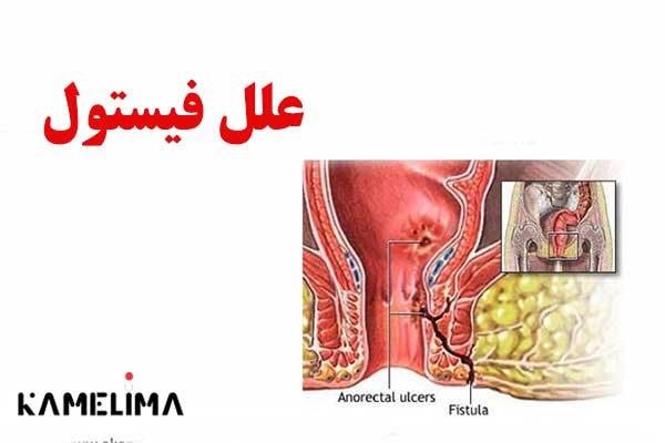 علائم، علل و موارد دیگر فیستول مقعدی