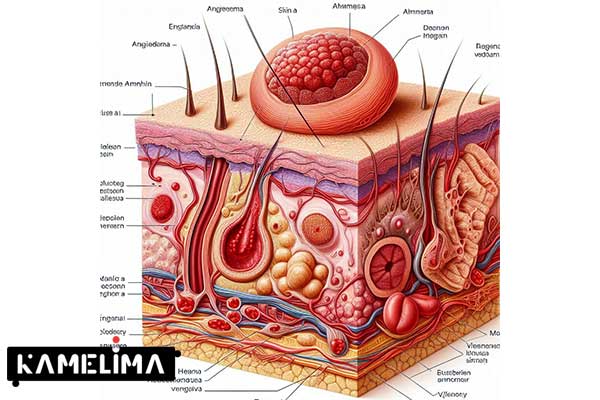 آخرین تحقیقات در مورد آنژیو ادم چیست؟